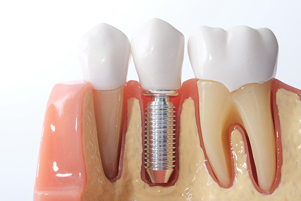 失った歯の機能と美しさを取り戻すインプラント治療
