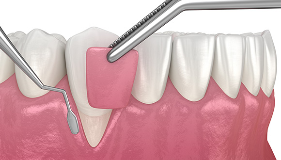 FGG(Free Gingival Graft:遊離歯肉移植術)