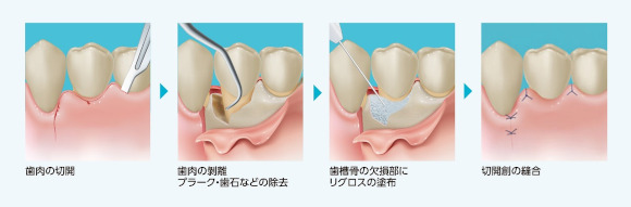 リグロス（歯周組織再生療法）